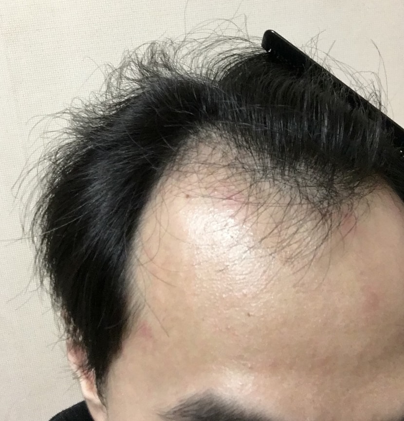 이마 오른쪽 (윗쪽에 점이 있습니다)