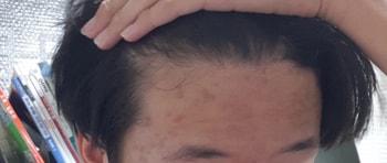 현재 헤어라인