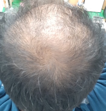 정수리