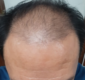 전두부