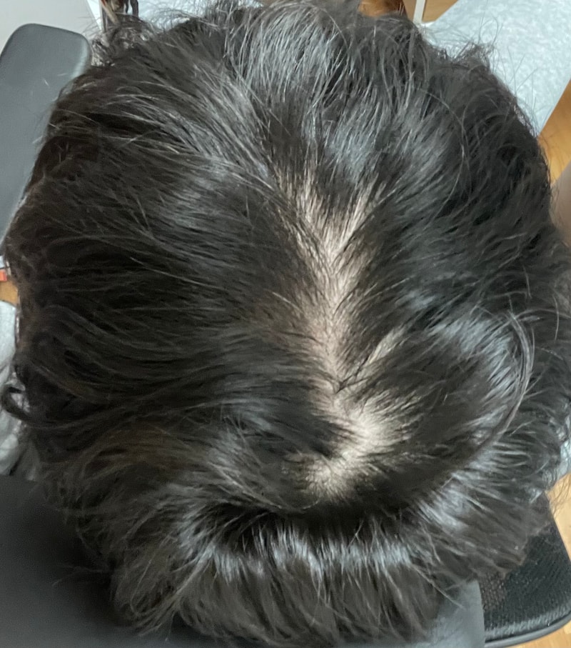 약먹은지 6년차 되는 탈모인입니다