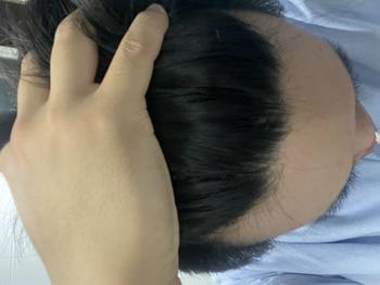 고3 남학생입니다 이번년도 1월부터 탈모 증세가 있어 고민이 많았습니다 머리도 많이 얇아졌고 유전력도 가지고 있습니다 지금 나이에 약을 시작해도 괜찮을까요?