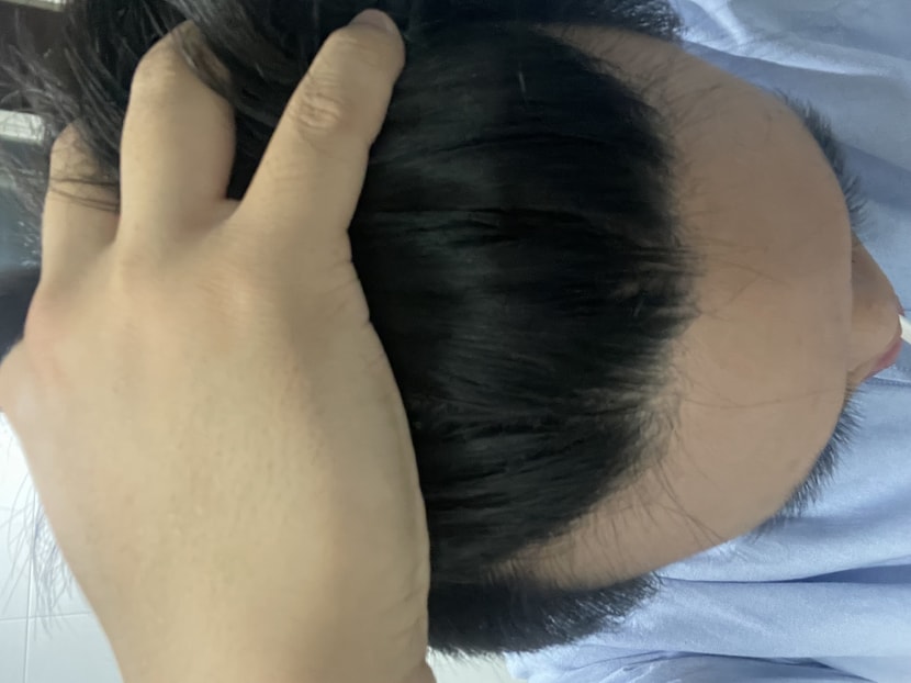 고3 남학생입니다 이번년도 1월부터 탈모 증세가 있어 고민이 많았습니다 머리도 많이 얇아졌고 유전력도 가지고 있습니다 지금 나이에 약을 시작해도 괜찮을까요?