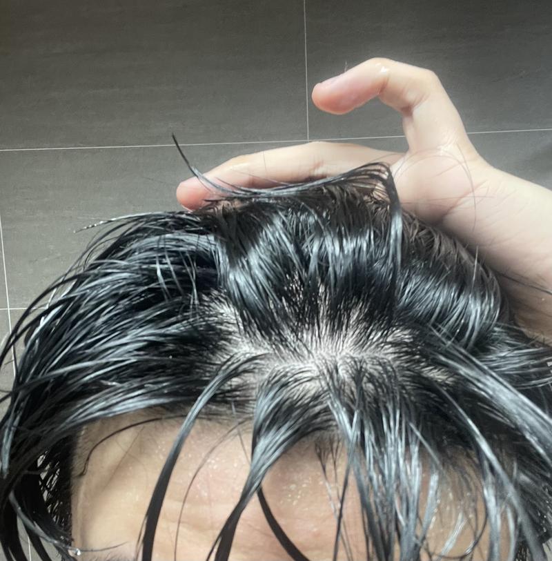 20-year-old diffuse hair loss