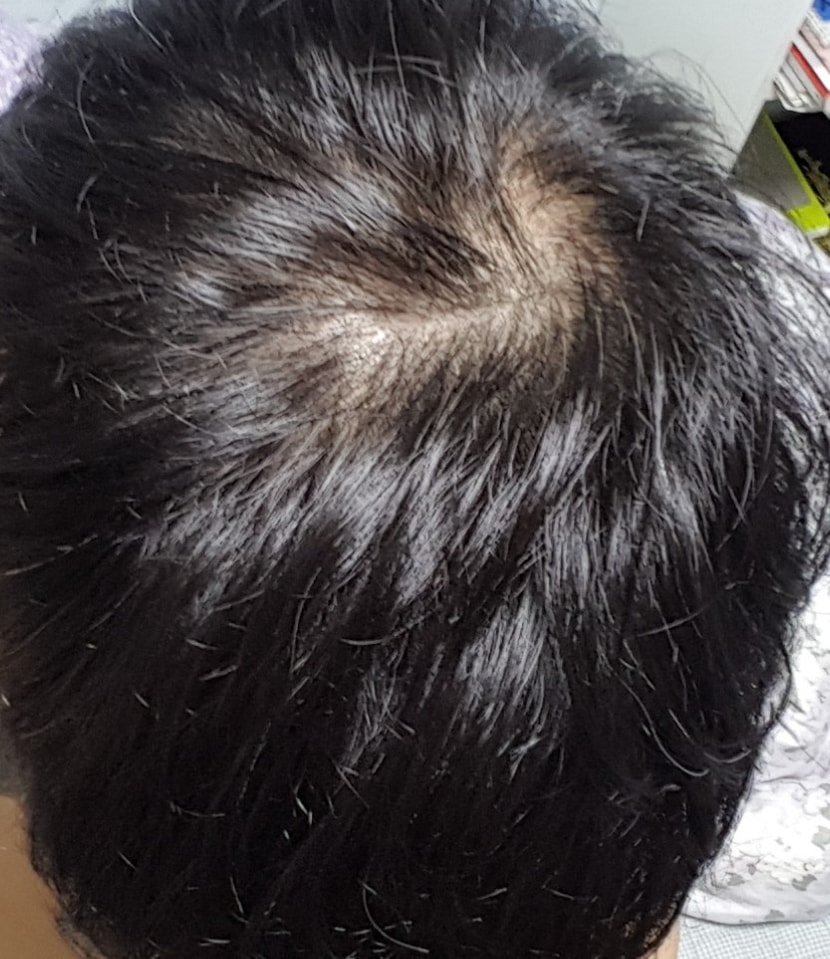 2년전 탈모치료 시작전.