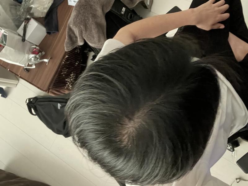 탈모 진행정도 봐주세요