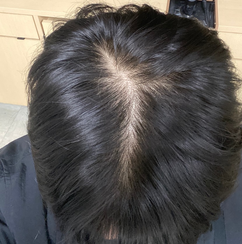 23년 10월 1년 복용후 말이 1년이지 6개월 먹고 거의 안먹음 