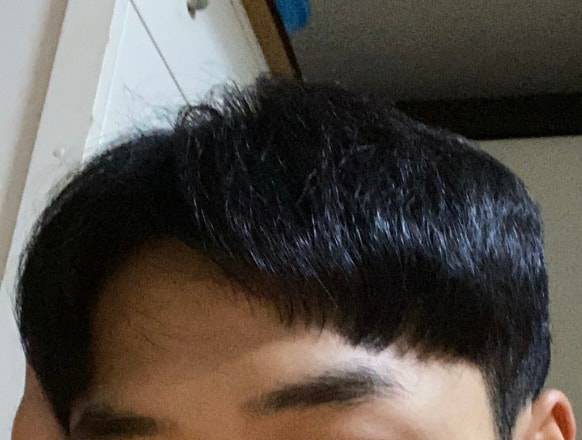 수술후 앞머리