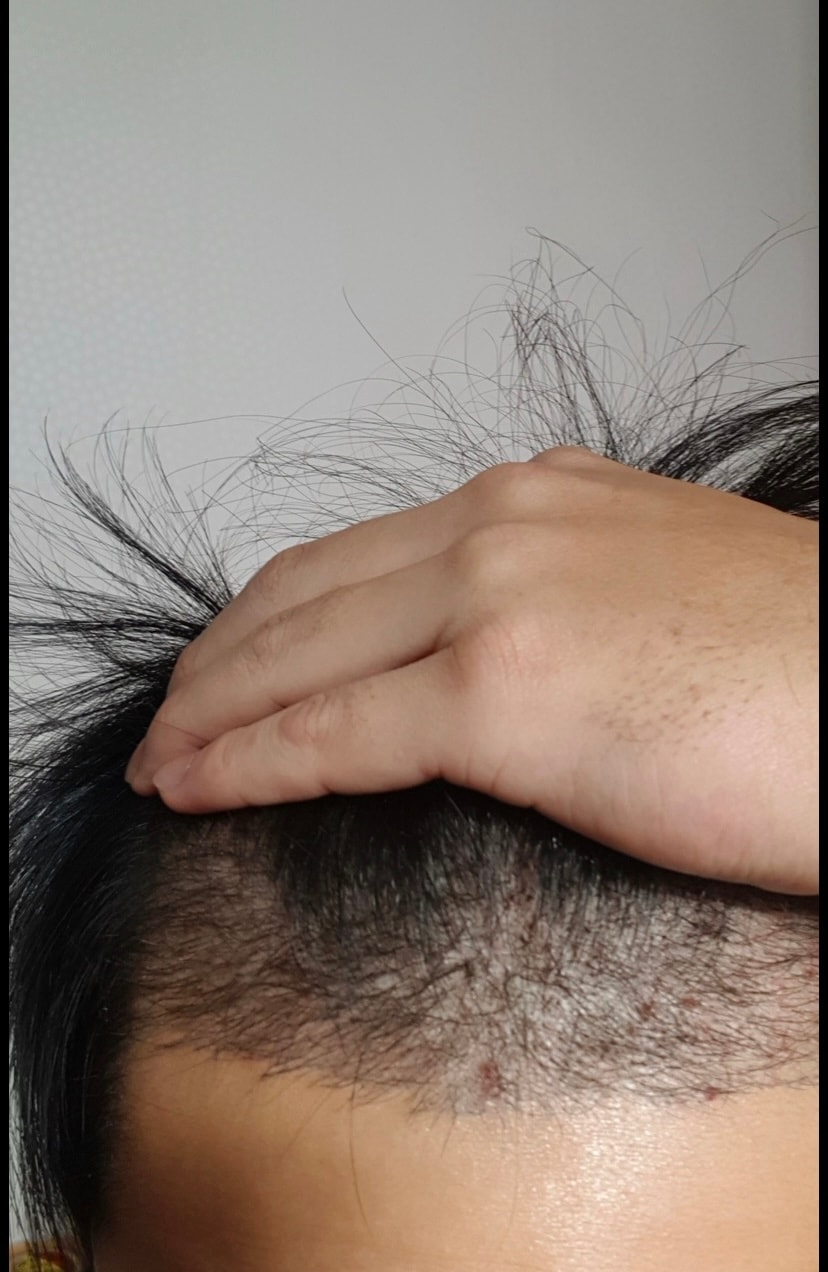 수술전 앞머리사진