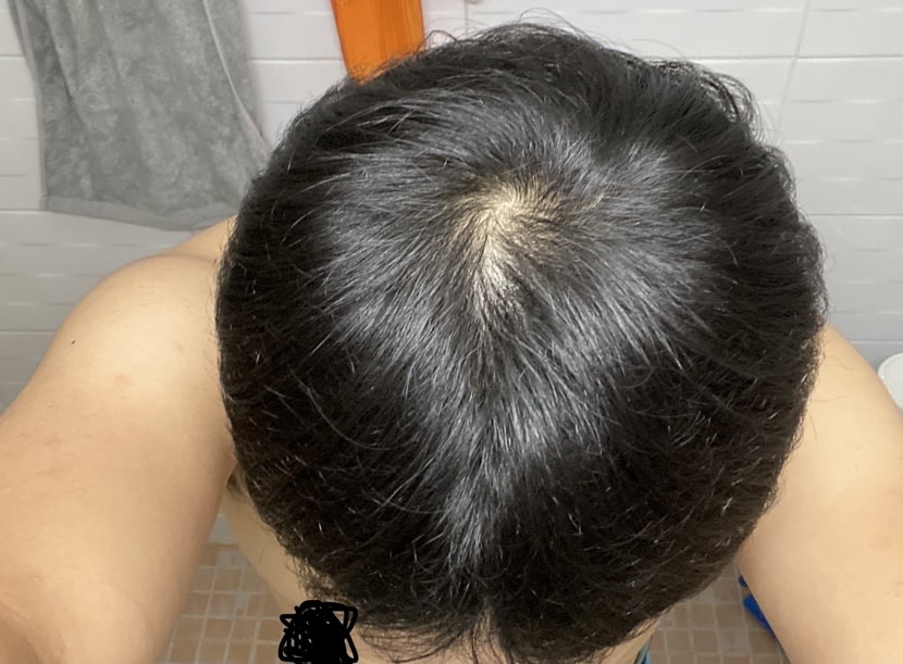 수술후 정수리사진(엄청 쎈 빛)