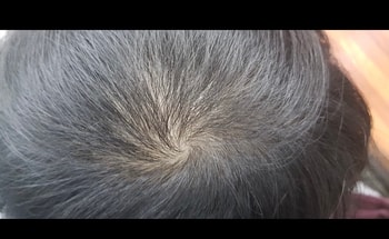 수술전 정수리사진