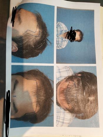 수술전 4000모 수술확정