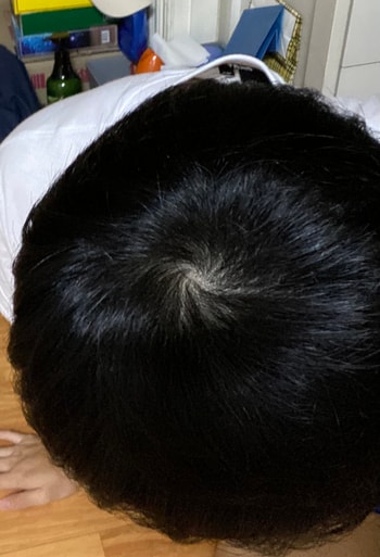 수술후 정수리사진(빛에 안비췄을때)