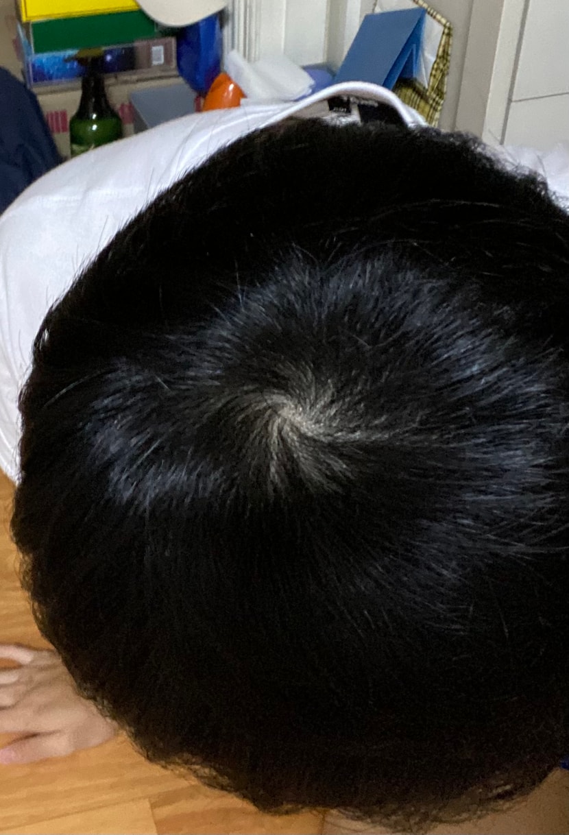 수술후 정수리사진(빛에 안비췄을때)