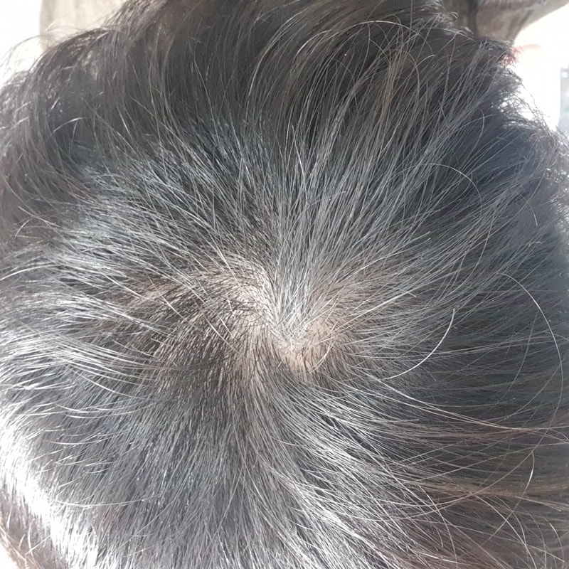 탈모 1단계 진단..?