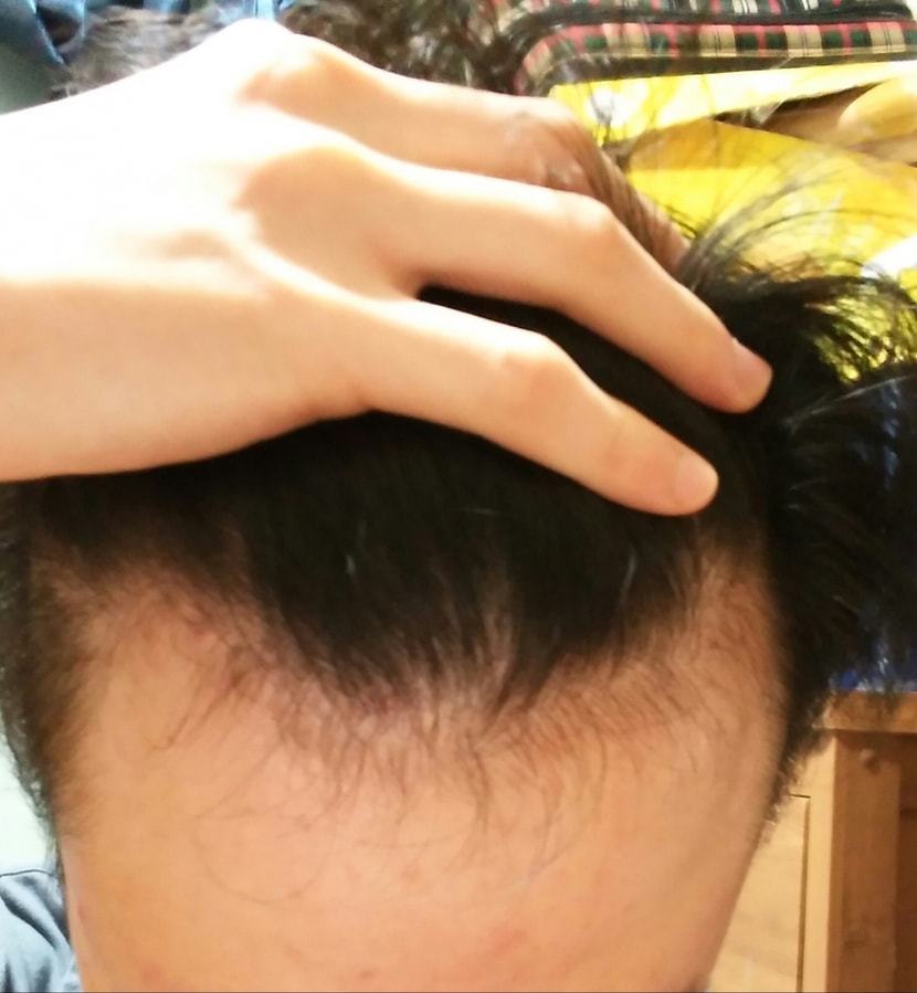 앞머리 M자 사진입니다