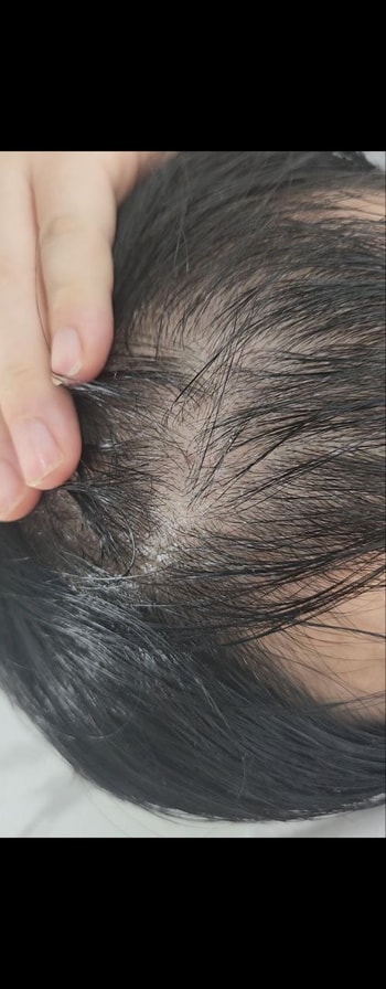 저는 모발이식 4개월 차입니다 저는 모발이식 전이랑 후를 비교햇을때 아직까지 변한게 하나도 없으며 잔머리 솜털도 안보입니다 이거는 실패인걸까요?