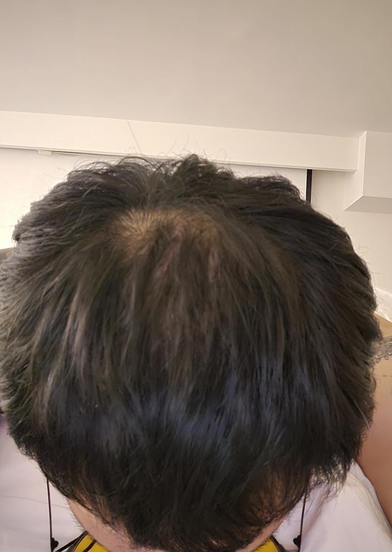 AGA治療薬を始めた方がいいですか？