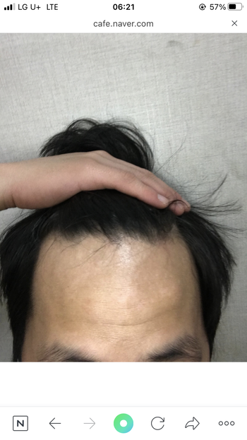 2018년 10월 사진 약복용시작 2020년3웡