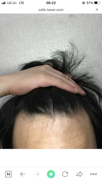 2018년 10월 사진 약복용시작 2020년3웡