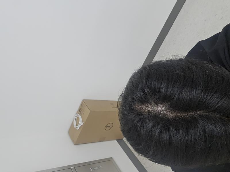 이소티논 장기 복용하다가 탈모진단받았습니다.