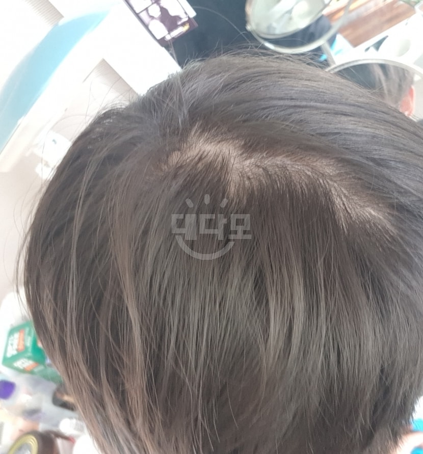 6개월 복용 중단후 사진입니다.
