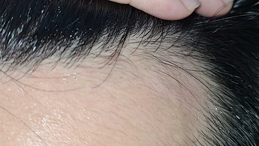 현재 오른쪽 이마