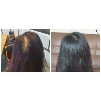 내 절친의 두피지방재생술 1년 후의 변화