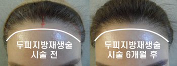 두피지방재생훌 6개월 후의 모습니다. 