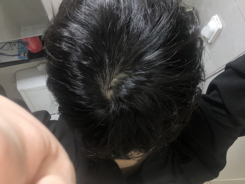 프로페시아 1년 후 사진입니다.