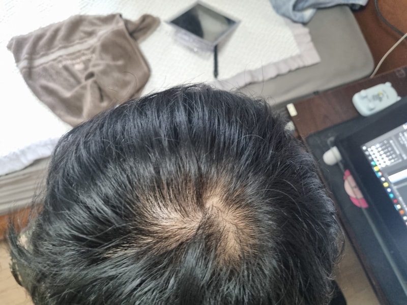 AGA治療薬を飲んで一週間目···