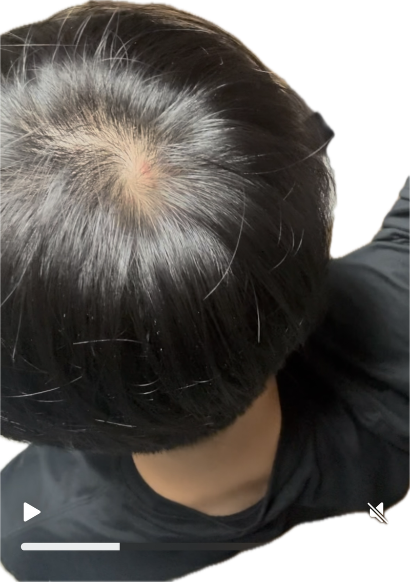 M자 모발이식 리터치 4개월 후 정수리 탈모가 심해졌어요..