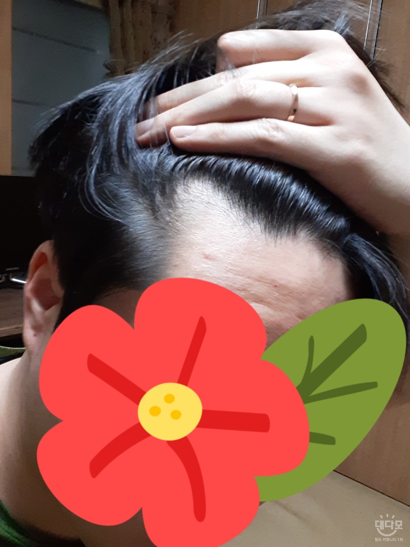 M字 8个月前后的对比照片及后记