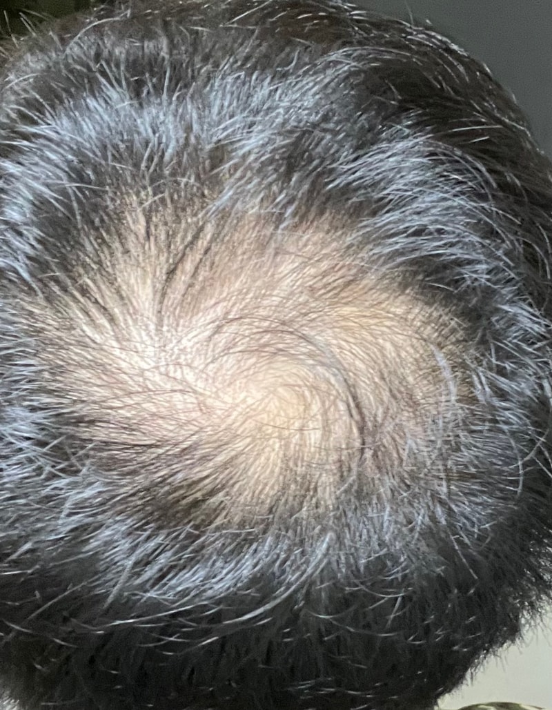 정수리 탈모 3주후 경과