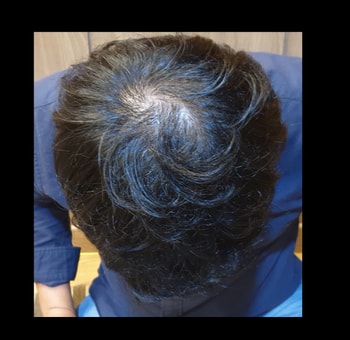 19년 8월28일 탈모치료 1개월 후