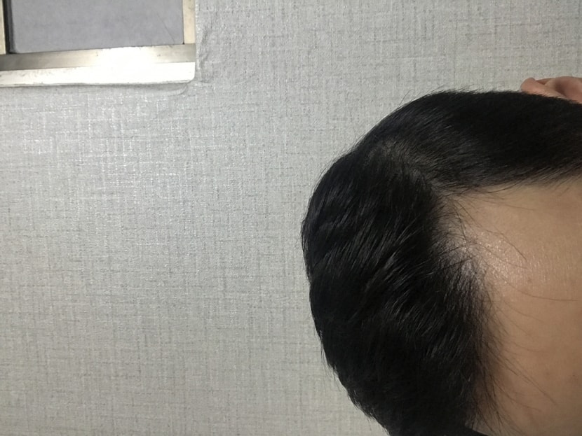 까올린 대각 좌측면