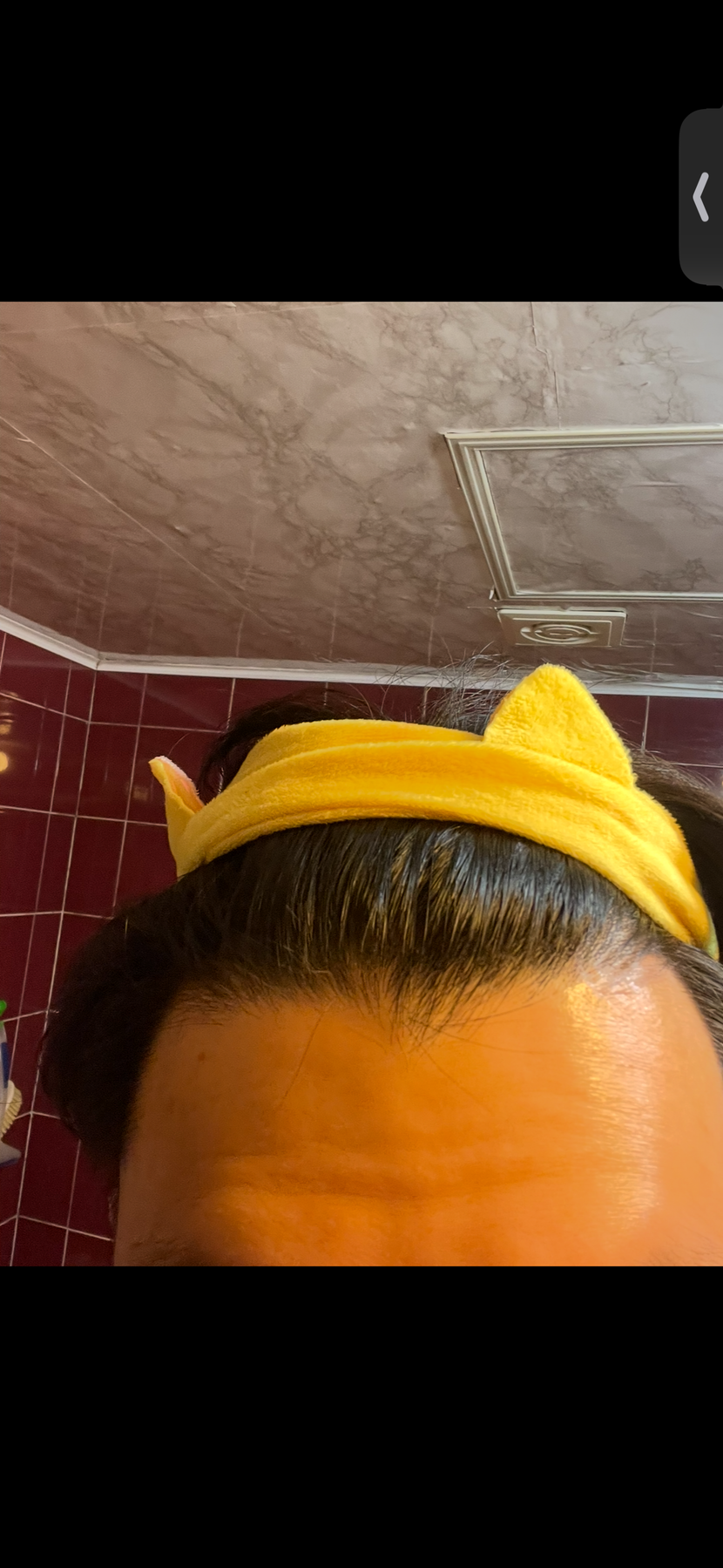 23년 3월 (최초진료전)이마