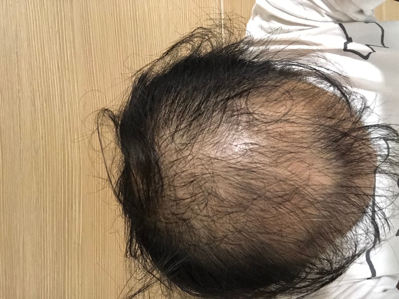 薄毛の初期に疑心暗鬼になってから20年..