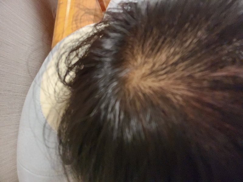 이거 탈모인가요?