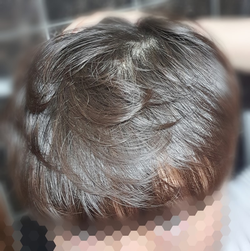 共享脱发治疗过程（Abodot 20 个月）