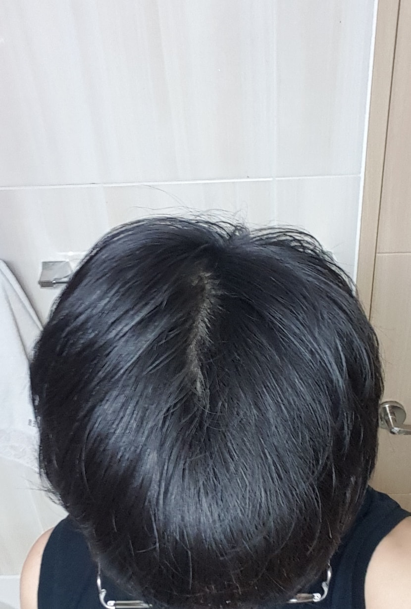 고개를 숙인 뒤 찍은 정수리 3