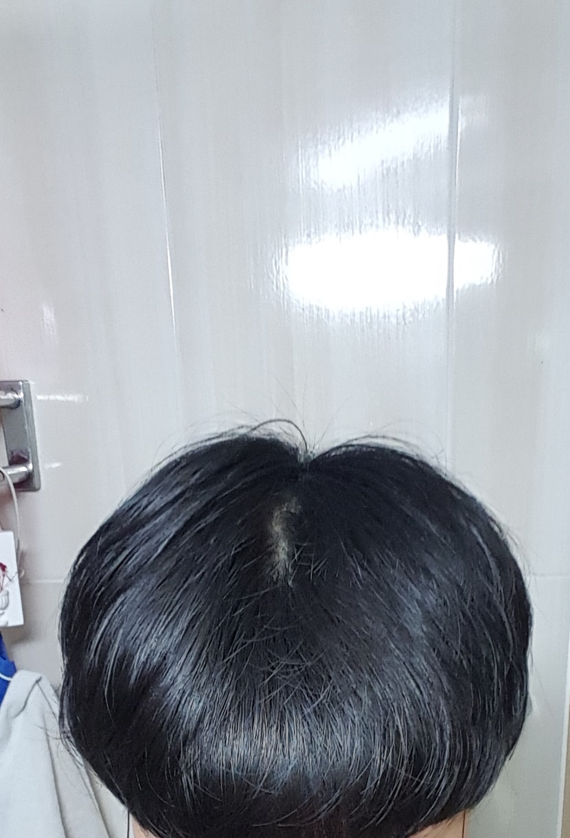 고개를 살짝 숙인 뒤 찍은 정수리 라인