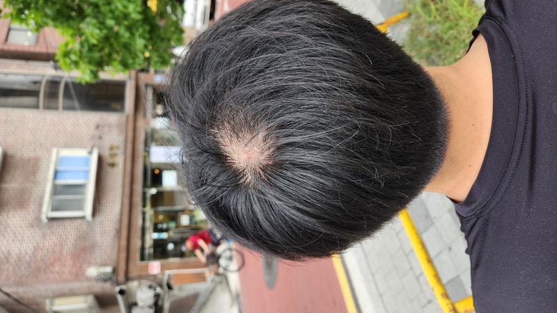 탈모 확정 후 우울증