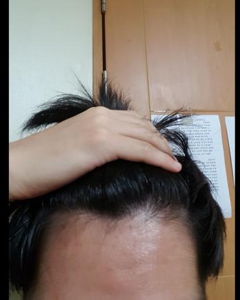 2014 프로페시아 복용중