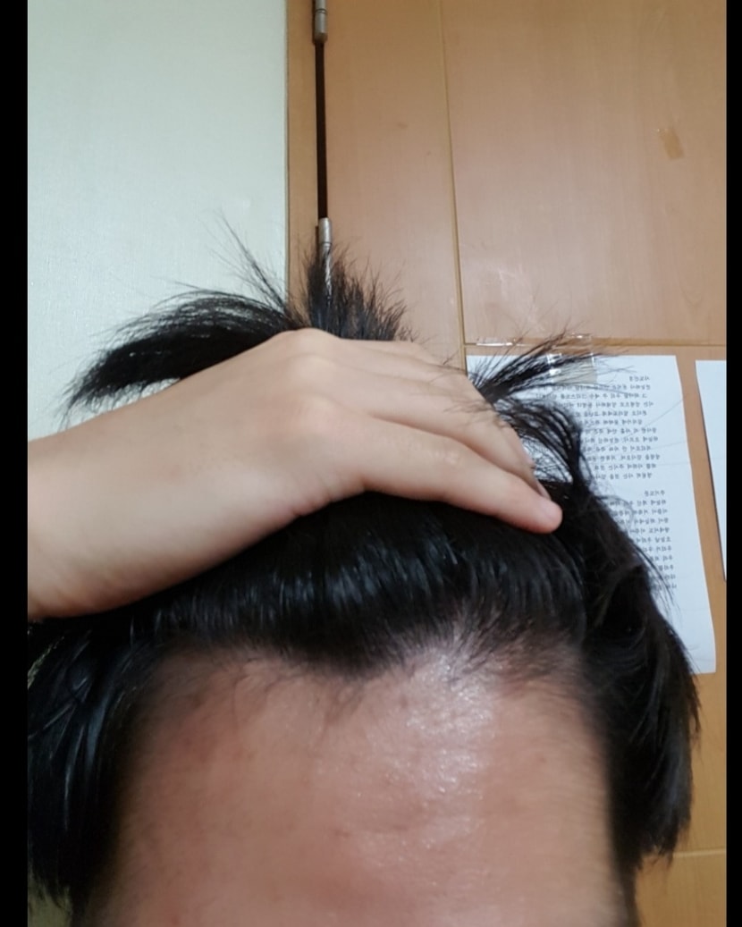 2014 프로페시아 복용중