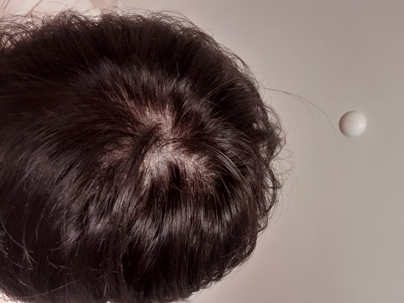 엑소좀,보톡스 치료 시작 전 사진