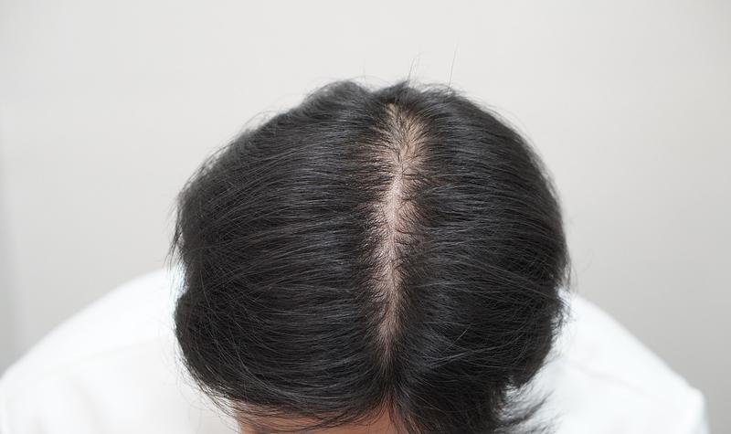 뉴헤어부산의원 탈모치료 7개월째 치료받고있습니다