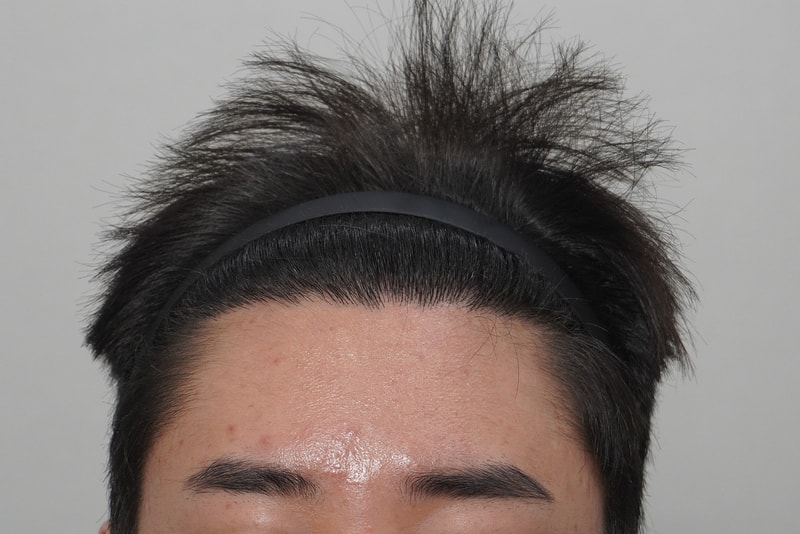 뉴헤어부산의원에서 탈모 치료 4회 차 후기 입니다