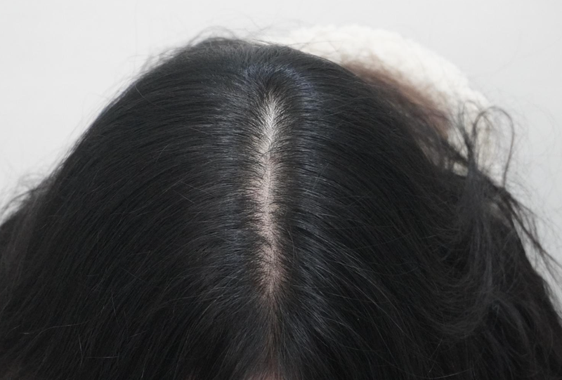 뉴헤어부산의원 탈모 주사 치료 8회차 후기