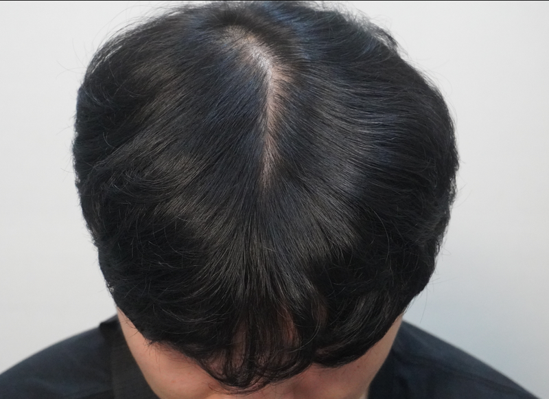 탈모진단 받고 뉴헤어 부산의원에서 치료 2회차 진행했습니다